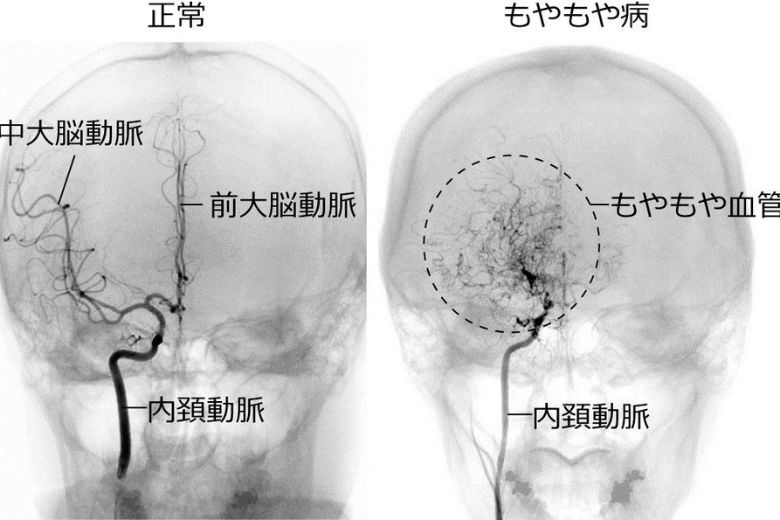 もやもや病とは
