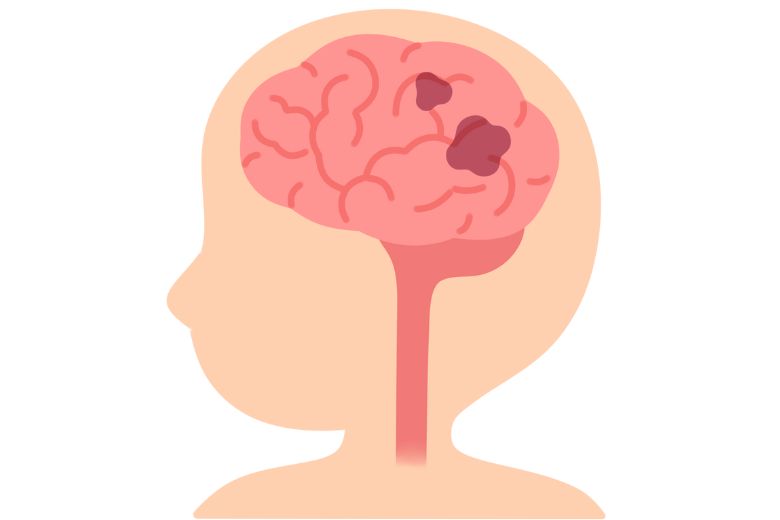 脳出血イラスト