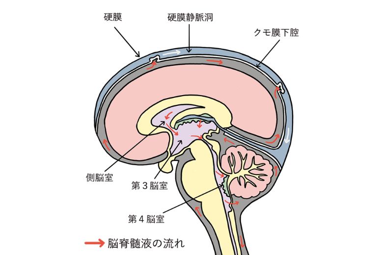 水頭症のイラスト