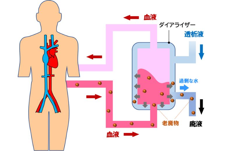 透析のイラスト