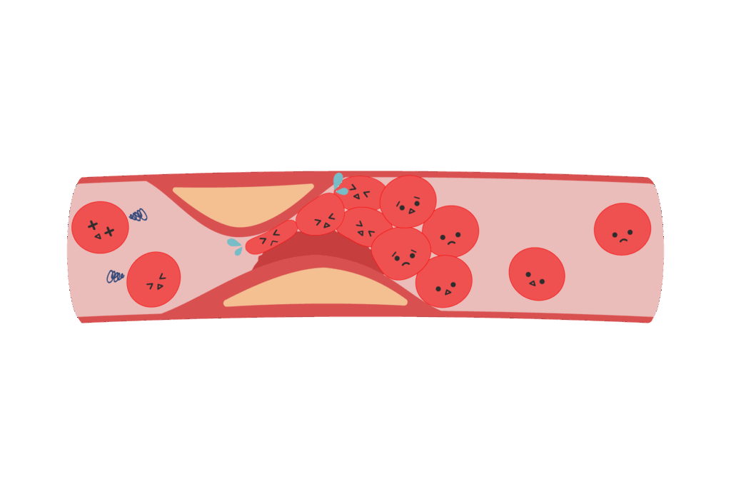 DICの基本的な病態
血栓形成の亢進