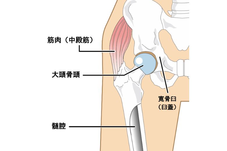 特発性大腿骨頭壊死症とは