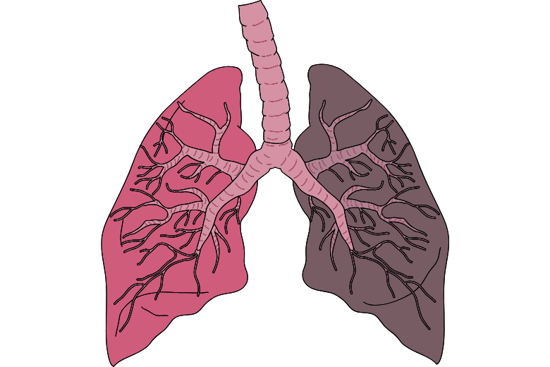 女性に多い肺腺がん　注目の原因3つ