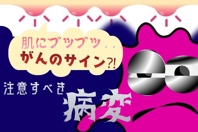 その「ブツブツ」がんのサインかも？注意すべき３つの病変