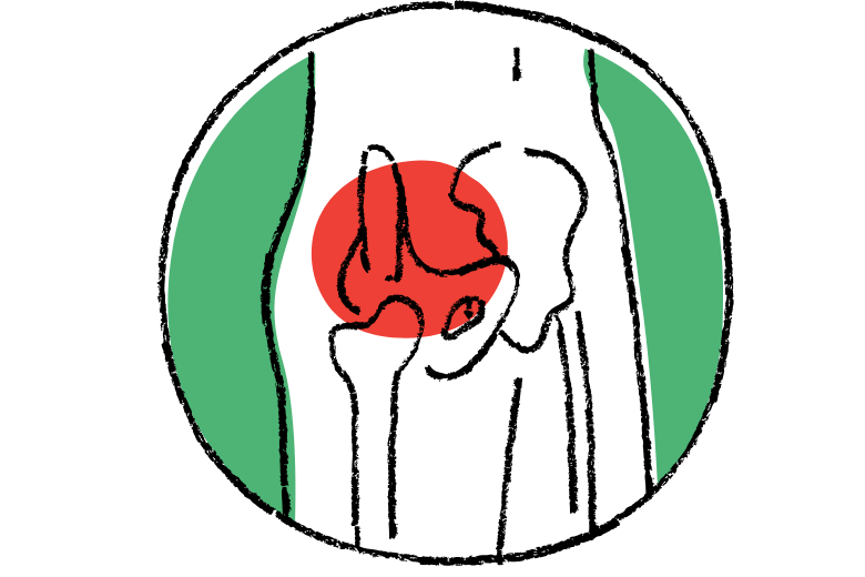 ■ ペルテス病(大腿骨頭壊死症の小児型)