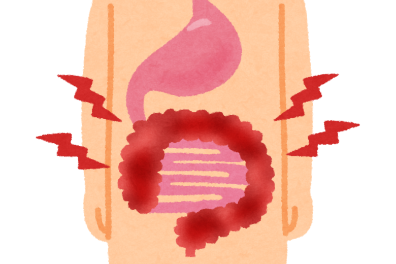 大腸がんでも同様の結果 ― 血中ビタミンDが生存率に影響