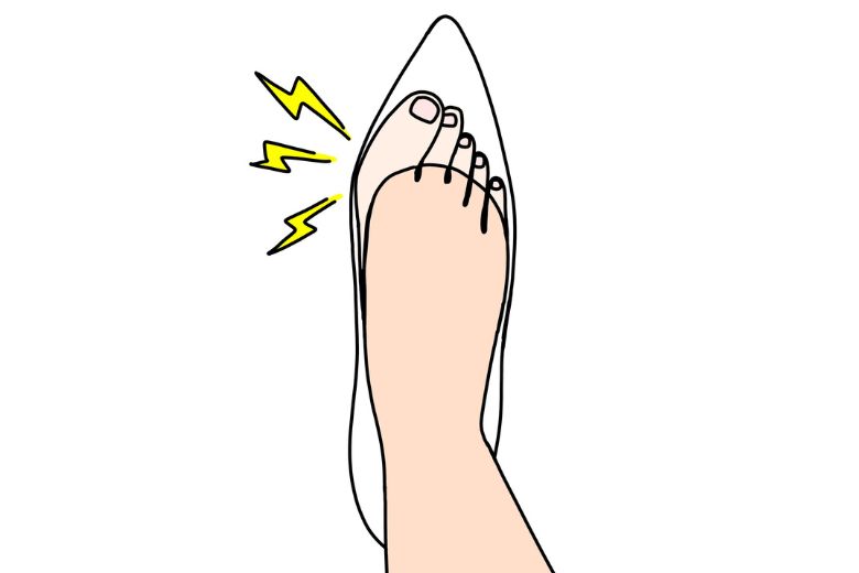 外反母趾の原因